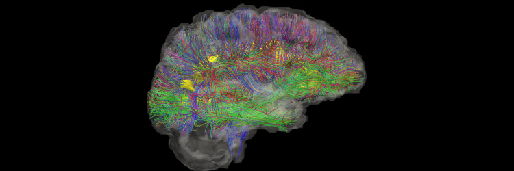 A brain with brain activity mapped in different bright colours